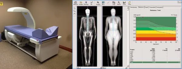 Φυσικοθεραπεία στην οστεοπόρωση (Osteoporosis) 5 Εξέταση οστεοπόρωσης με το σύστημα DEXA