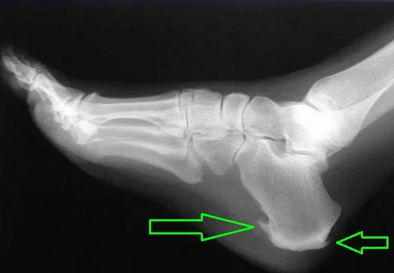 Φυσικοθεραπεία στην άκανθα πτέρνας (Heel spur) 3 Άκανθα πτέρνας ακτινογραφία