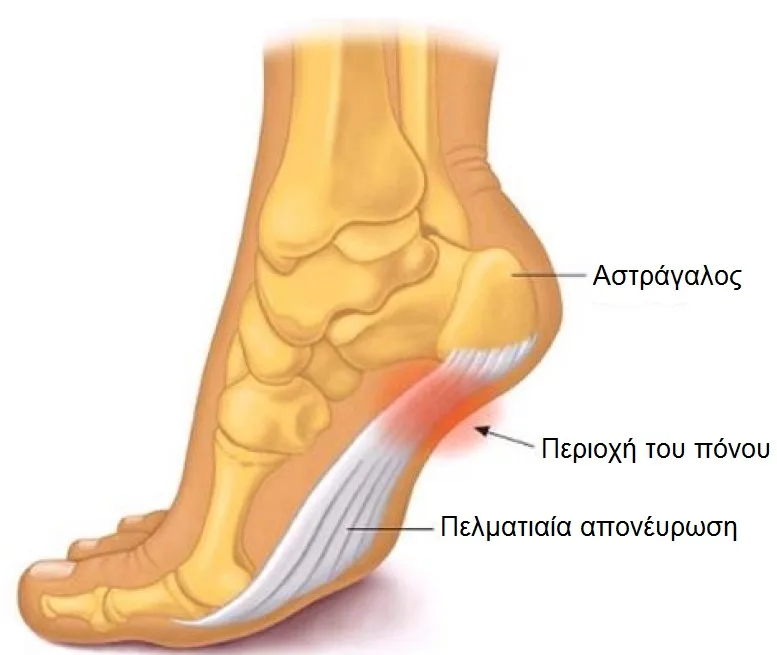 Φυσικοθεραπεία στην άκανθα πτέρνας (Heel spur) 2 Άκανθα πτέρνας πόνος