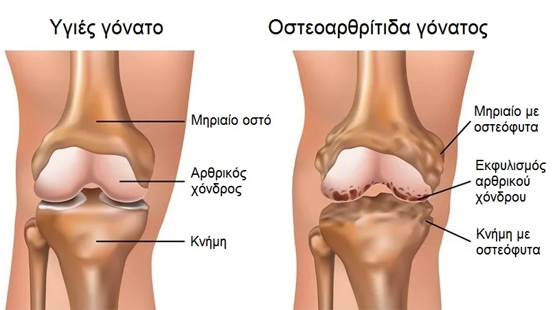 Φυσικοθεραπεία στην οστεοαρθρίτιδα γόνατος (Knee osteoarthritis) 2 Αρθρίτιδα γόνατος ανατομία