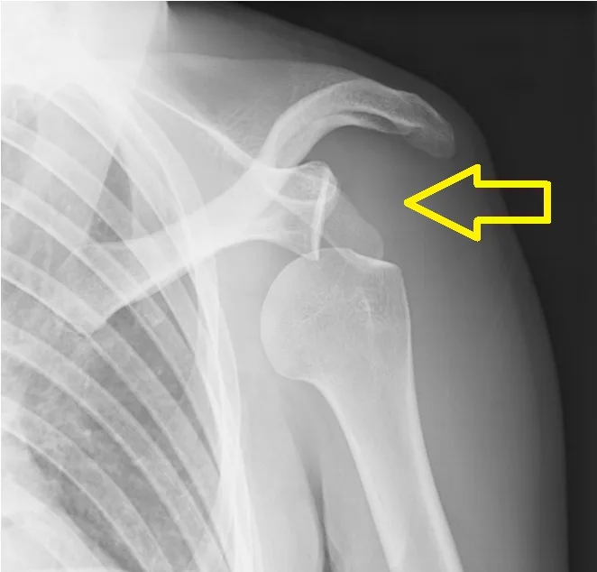 Φυσικοθεραπεία στην αστάθεια του ώμου (Shoulder instability) 3 Αστάθεια ώμου ακτινογραφία