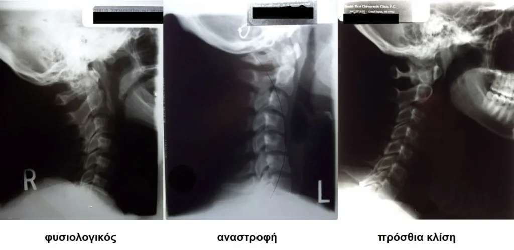 Φυσικοθεραπεία στο αυχενικό σύνδρομο (Cervical syndrome) 2 Αυχενικό σύνδρομο ακτινογραφία