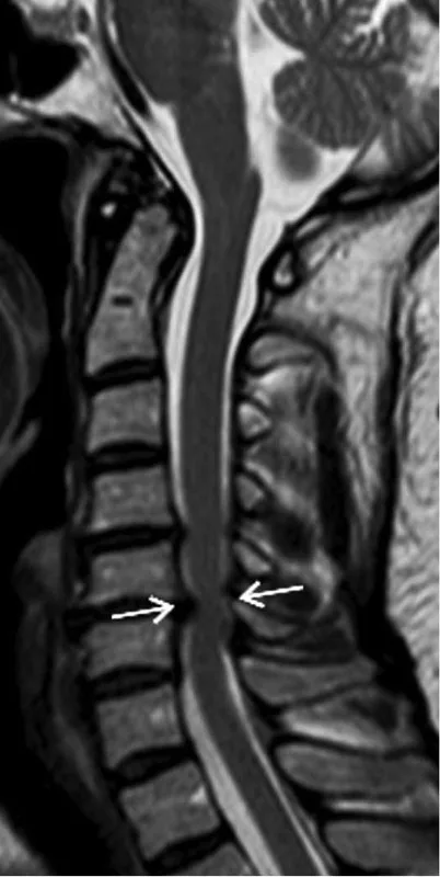 Φυσικοθεραπεία στο αυχενικό σύνδρομο (Cervical syndrome) 4 Αυχενικό σύνδρομο μαγνητική τομογραφία