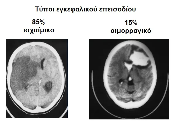 Φυσικοθεραπεία στο εγκεφαλικό επεισόδιο (Stroke) 2 Εγκεφαλικό επεισόδιο μαγνητική τομογραφία