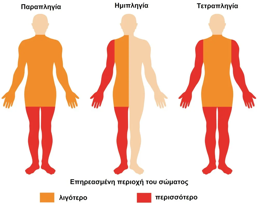 Φυσικοθεραπεία στο εγκεφαλικό επεισόδιο (Stroke) 3 Εγκεφαλικό επεισόδιο συμπτώματα