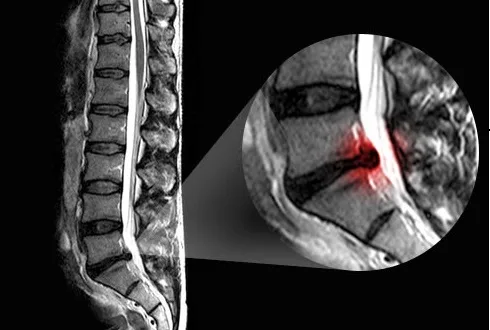 Φυσικοθεραπεία στην ισχιαλγία (Sciatica) 3 Ισχιαλγία μαγνητική τομογραφία