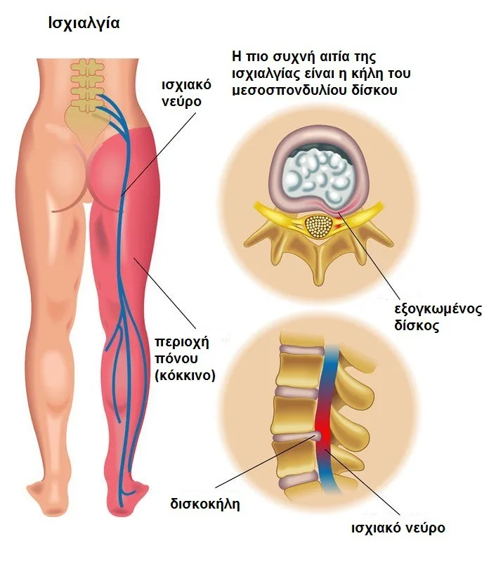 Φυσικοθεραπεία στην ισχιαλγία (Sciatica) 2 Ισχιαλγία συμπτώματα