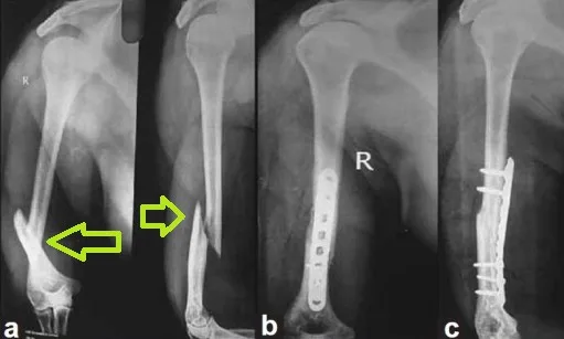 Φυσικοθεραπεία στα κατάγματα (Fractures) 3 Κάταγμα ακτινογραφία