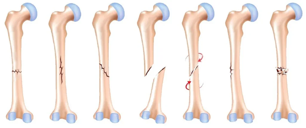 Φυσικοθεραπεία στα κατάγματα (Fractures) 2 Κάταγμα τύποι