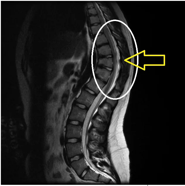 Φυσικοθεραπεία στην κύφωση (Kyphosis) 3 Κύφωση μαγνητική τομογραφία