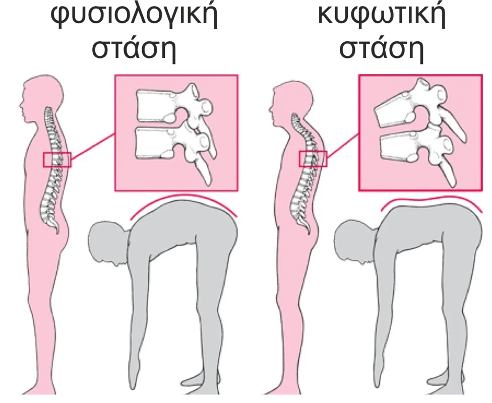 Φυσικοθεραπεία στην κύφωση (Kyphosis) 2 Κύφωση