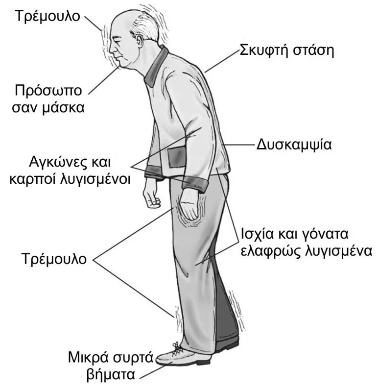 Φυσικοθεραπεία στη νόσο του Πάρκινσον (Parkinson) 2 Νόσος Parkinson συμπτώματα