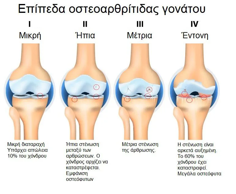 Φυσικοθεραπεία στην οστεοαρθρίτιδα γόνατος (Knee osteoarthritis) 3 Οστεοαρθρίτιδα γόνατος στάδια εκφυλισμού