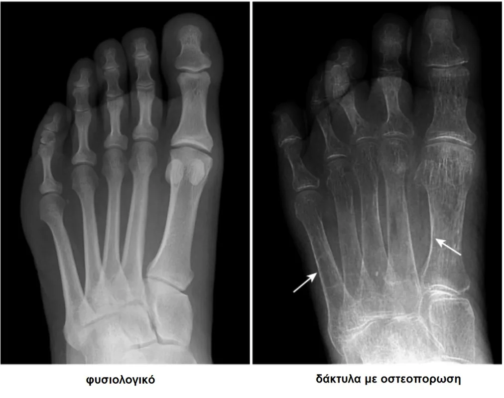 Φυσικοθεραπεία στην οστεοπόρωση (Osteoporosis) 4 Οστεοπόρωση ακτινογραφία
