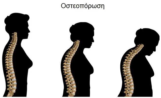 Φυσικοθεραπεία στην οστεοπόρωση (Osteoporosis) 3 Οστεοπόρωση στάδια