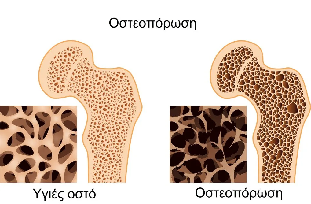 Φυσικοθεραπεία στην οστεοπόρωση (Osteoporosis) 2 Οστεοπόρωση συμπτώματα