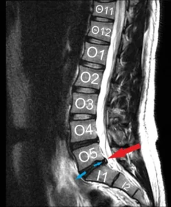 Φυσικοθεραπεία στην οσφυαλγία (Lumbar radiculopathy / Low back pain) 4 Οσφυαλγία μαγνητική τομογραφία