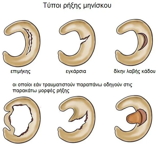 Φυσικοθεραπεία στη ρήξη μηνίσκου (Meniscus tear) 2 Ρήξη μηνίσκου είδη