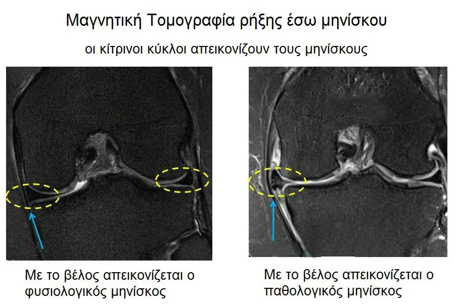 Φυσικοθεραπεία στη ρήξη μηνίσκου (Meniscus tear) 3 Ρήξη μηνίσκου μαγνητική τομογραφία