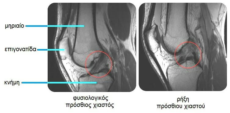 Φυσικοθεραπεία στη ρήξη χιαστού (Cruciate ligament tear) 3 Ρήξη χιαστού μαγνητική τομογραφία