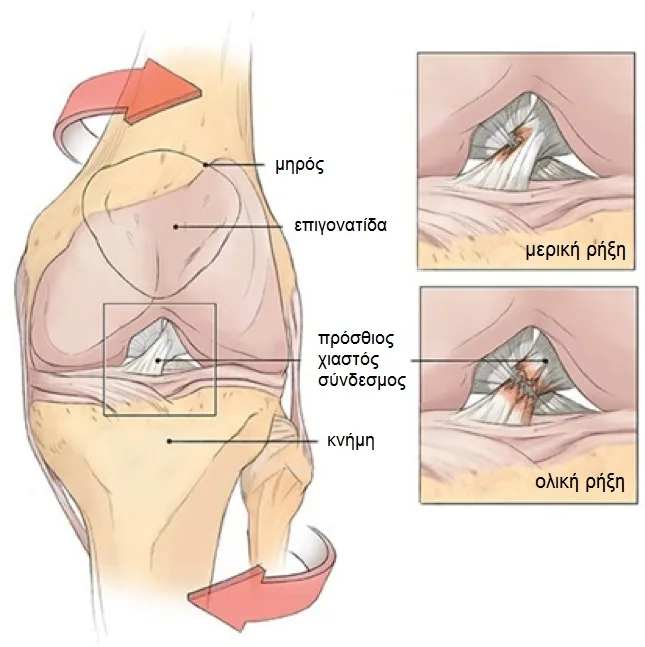 Φυσικοθεραπεία στη ρήξη χιαστού (Cruciate ligament tear) 2 Ρήξη χιαστού συμπτώματα