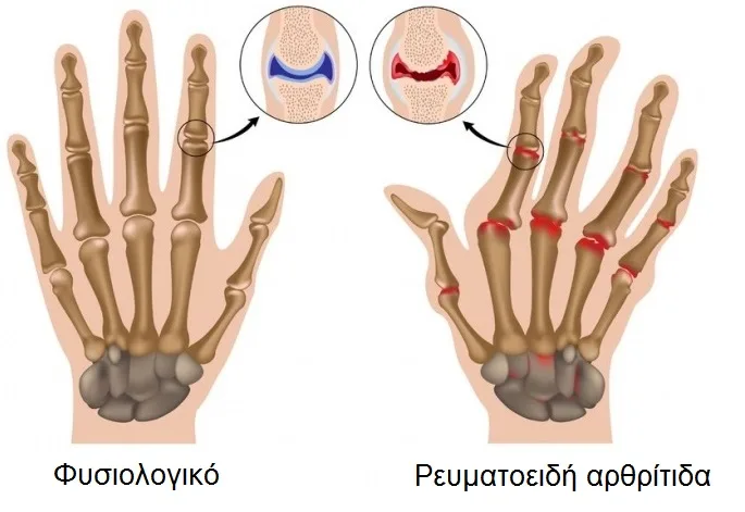 Φυσικοθεραπεία στην αρθρίτιδα (Arthritis) 2 Ρευματοειδής αρθρίτιδα στα χέρια