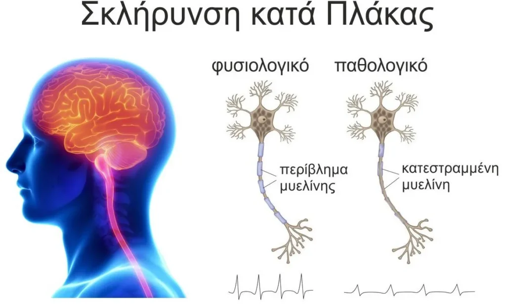 Φυσικοθεραπεία στη Σκλήρυνση κατά Πλάκας (Multiple sclerosis) 2 Σκλήρυνση κατά πλάκας νεύρα