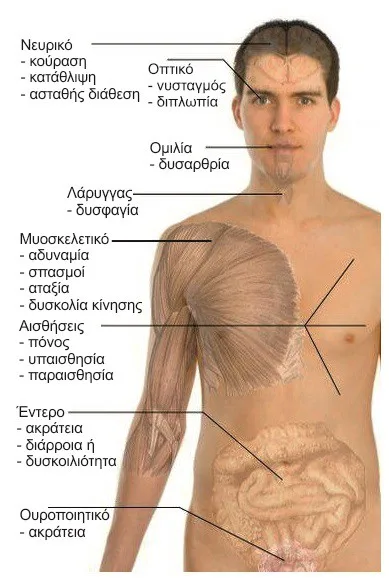 Φυσικοθεραπεία στη Σκλήρυνση κατά Πλάκας (Multiple sclerosis) 3 Σκλήρυνση κατά πλάκας συμπτώματα