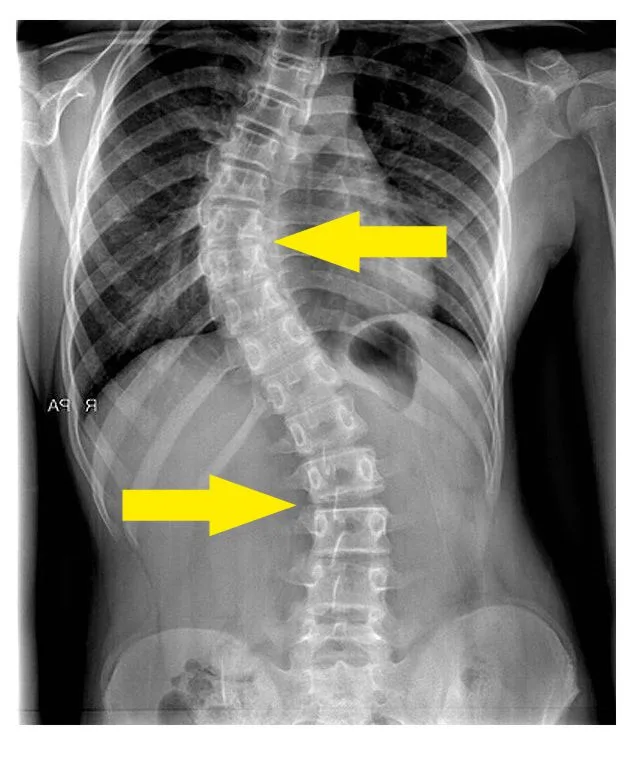 Φυσικοθεραπεία στη σκολίωση (Scoliosis) 3 Σκολίωση ακτινογραφία