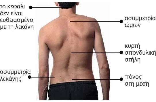 Φυσικοθεραπεία στη σκολίωση (Scoliosis) 2 Σκολίωση συμπτώματα