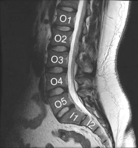 Φυσικοθεραπεία στην οσφυαλγία (Lumbar radiculopathy / Low back pain) 3 Φυσιολογική μαγνητική τομογραφία οσφυϊκής μοίρας