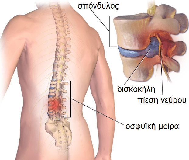 Φυσικοθεραπεία στην οσφυαλγία (Lumbar radiculopathy / Low back pain) 2 οσφυαλγία-δισκοκήλη