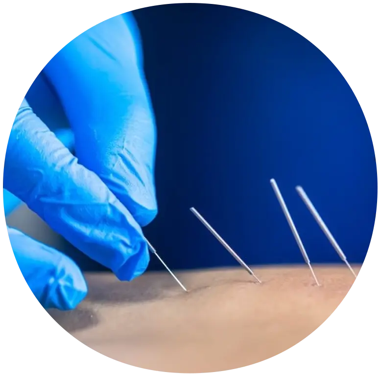 Χρονολόγιο 31 Dry Needling